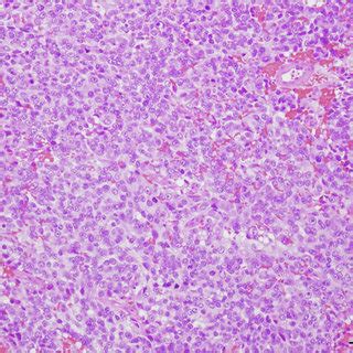 Histopathology Findings A H E Stain 10 B Positive Staining For PSA