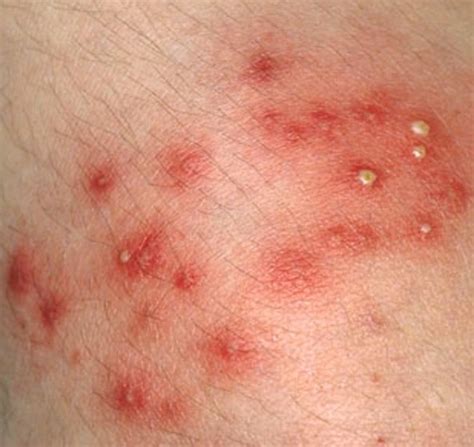 Is It Common To Only Get Prescribed An Antibiotic Cream For A Staph