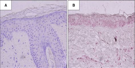 Melanocytes In The Basal Layer Of Epidermis Stained By Download