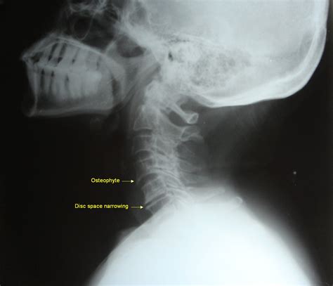 In males, the prevalence was 13% in the third. Spondylotic changes - cervical vertebrae - X-ray « PG Blazer