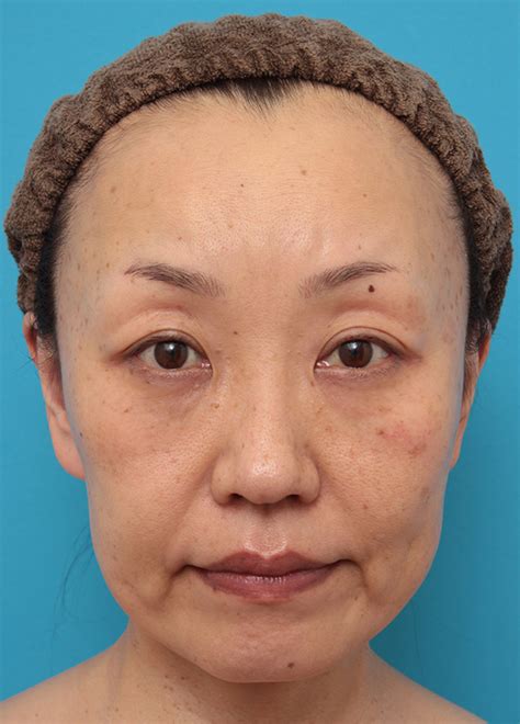 50代女性に小顔専用脂肪溶解注射メソシェイプフェイスを行った症例写真：美容外科 高須クリニック