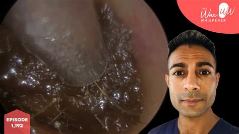 1192 Impacted Masses Of Dark Ear Wax Removal Youtube