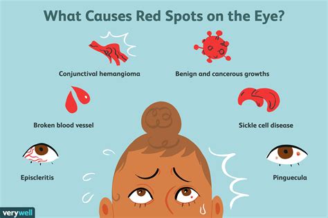 Red Spot On Eye