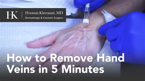 How To Get Rid Of Hand Veins In 5 Minutes By Dr Hooman Khorasani Youtube