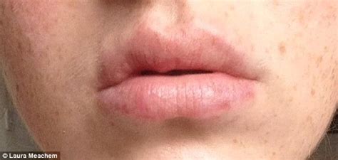 Beauty Blogger Laura Meachem Is Left With Lumpy Lips After Botched Filler Injections Daily