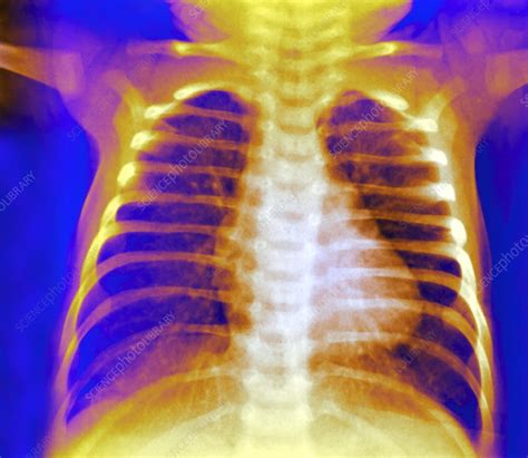 Healthy Chest X Ray Stock Image P5900250 Science Photo Library
