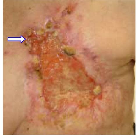 A biopsy for inflammatory breast cancer is a biopsy of the skin of the breast. Local chest wall recurrence of inflammatory breast cancer ...