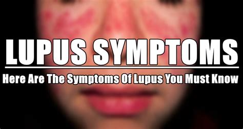 Lupus Symptoms Here Are The Symptoms Of Lupus You Must Know