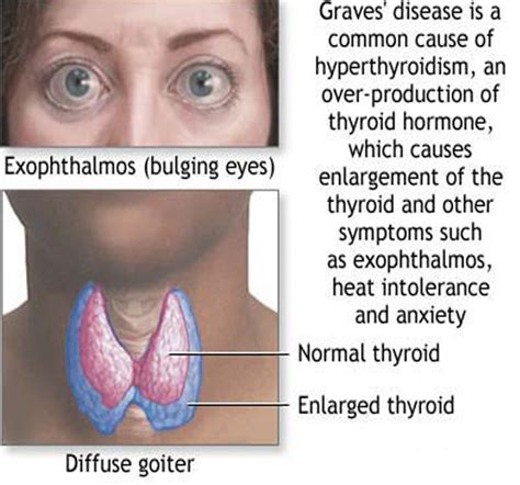 Exophthalmic Goitre Liberal Dictionary