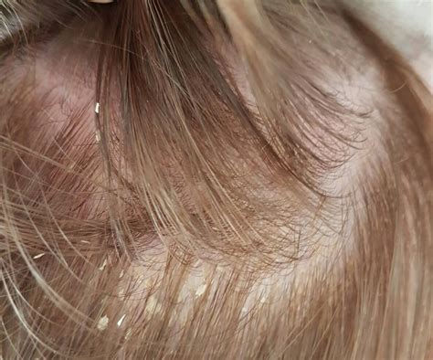 Scalp Dermatitis Treatment And Symptoms With Images Scalp
