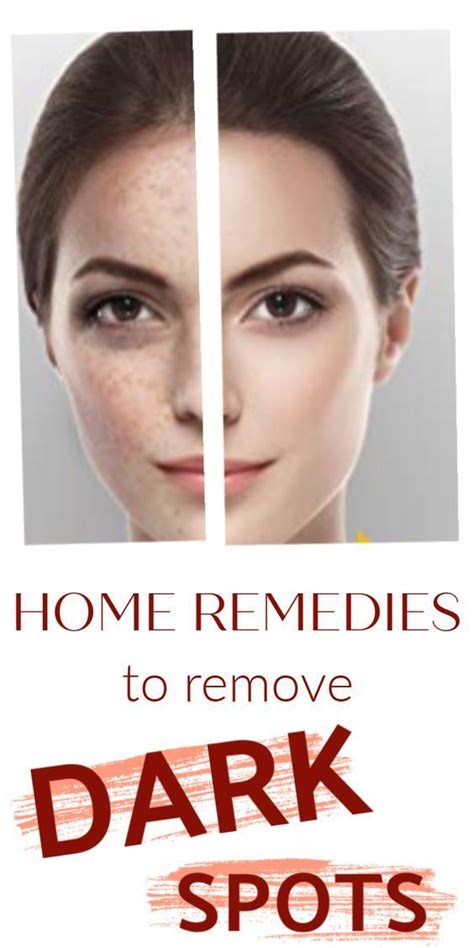 Home Remedies For Dark Spots You Must Try Now Skin Care Dark Spots