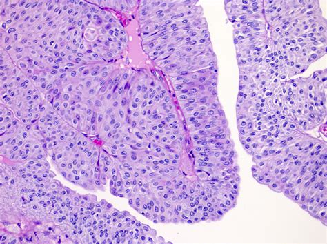 Pathology Outlines Noninvasive Papillary Urothelial Carcinoma Low Grade