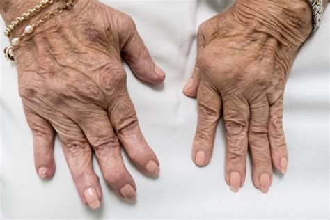 rheumatoid arthritis hands singapore sports and orthopaedic clinic