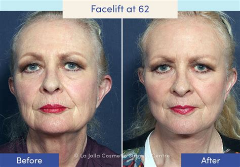 Facelift Before After Photos What A Facelift Looks Like At