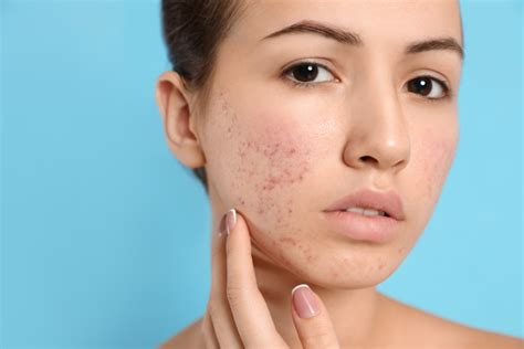 Acne 101 Melbourne Skin And Dermatology
