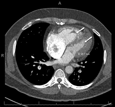 Cureus Massive Pulmonary Embolism As A Cause Of Cardiac Arrest Navigating Unknowns In Life