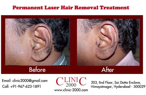 Laser Hair Removal For The Ears Clinic2000