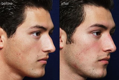 Male noses are usually larger than those of women, with a broader nasal bone. Nip and Tuck: Plastic Surgery for Men