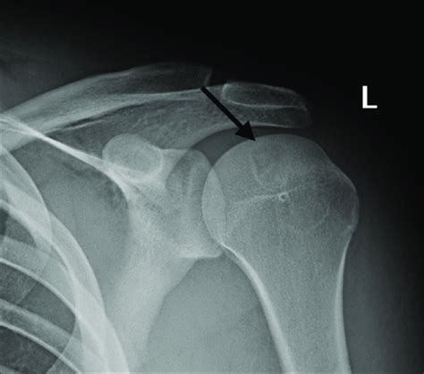 Radiograph Of The Left Shoulder Ap View A Rounded Lytic Lesion Is