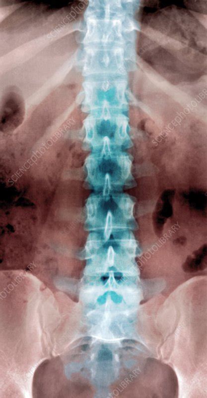 Normal Lumbar Spine X Ray Stock Image P1160849 Science Photo