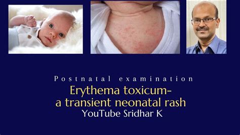 Erythema Toxicum A Transient Neonatal Rash Dr Sridhar K Rash