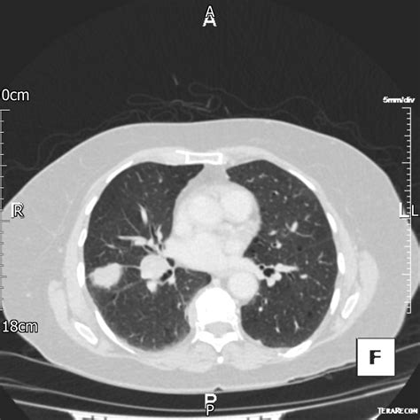 Malignant Pleural Mesothelioma Presenting As Perifissural Nodules