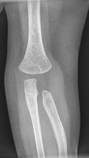 Radial Head Dislocation Anteroposterior Radiograph Of The Left Elbow