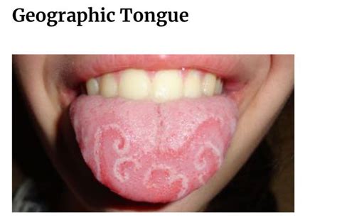 Geographic Tongue Medizzy