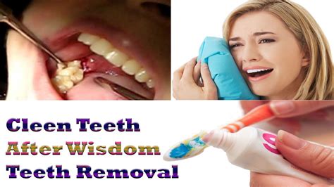 Wisdom Teeth Removal How To Clean Your Teeth After Wisdom Teeth