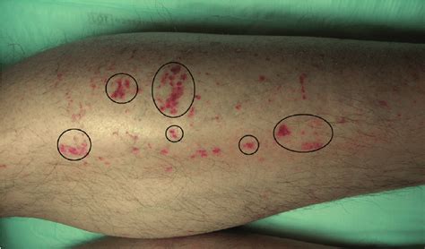 Petechiae On The Shin Of The Left Leg In Campaign 1 Circles Outline