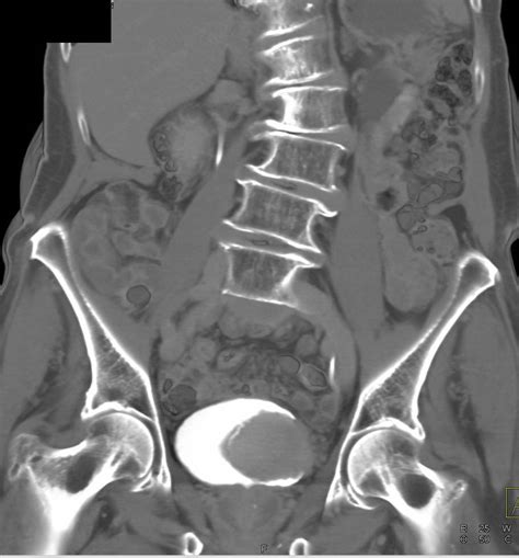 Bladder Cancer With Ct Urography Genitourinary Case Studies Ctisus