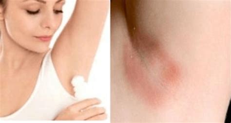 How to get rid of armpit odor. Top 10 Natural Remedies to Get Rid of Armpit Rash Fast