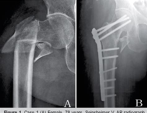 Pdf Treatment Of Femoral Subtrochanteric Fractures With Proximal