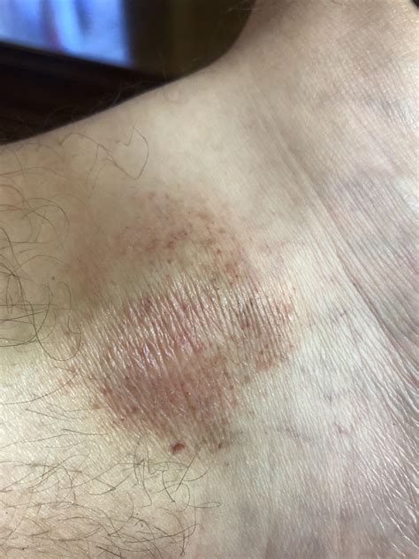 Ive Had This Discolored Rash On My Ankle For About 4 Or 5 Months Just