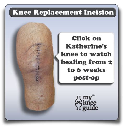 The Wound Important Considerations To Understand Knee Replacement