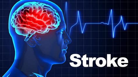 Know The Symptoms Of Stroke And Reduce Your Risk Kneb