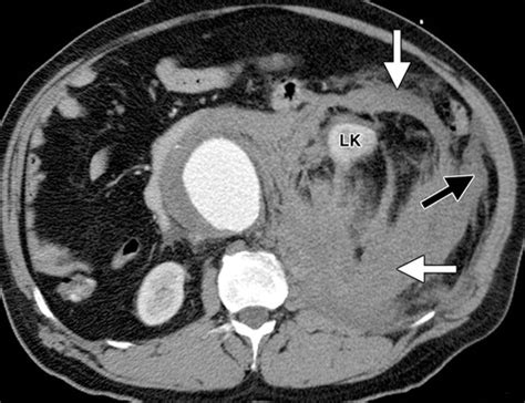 Peritoneal And Retroperitoneal Anatomy And Its Relevance For Cross