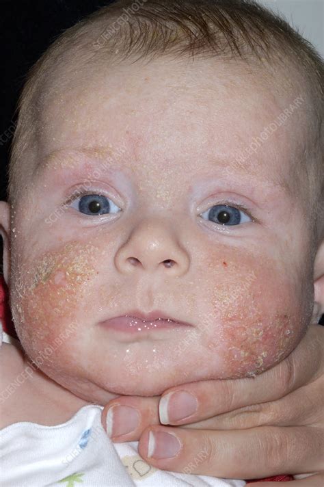 Infected Eczema On A Babys Face Stock Image M1500302 Science