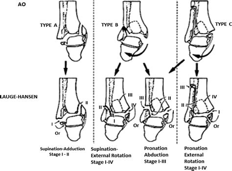 Figure From Modified Classification Of Posterior Malleolus Fracture My Xxx Hot Girl