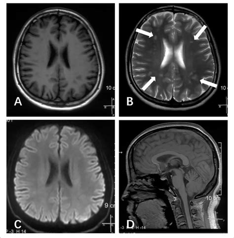 Brain Mri Scans Of This Patient Performed At Age Of 16 Years During