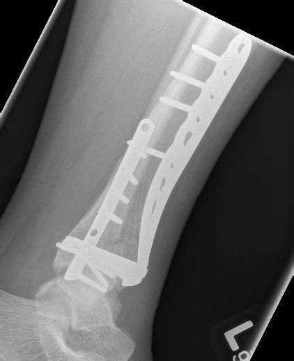 Distal Tibial Fractures The Bone Babe
