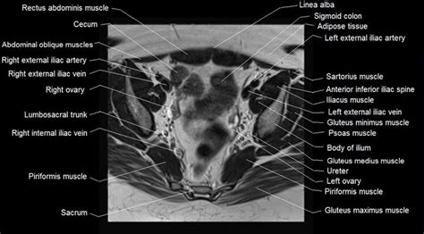 The pelvic floor or pelvic diaphragm is composed of muscle fibers of the levator ani, the coccygeus muscle, and associated connective tissue which span the area underneath the pelvis. mri female pelvis anatomy axial image 13 | Pelvis anatomy ...