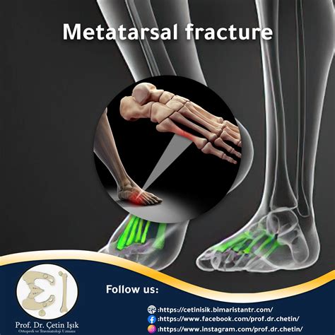 Metatarsal Fracture From Diagnosis To Treatment Dr How Are You