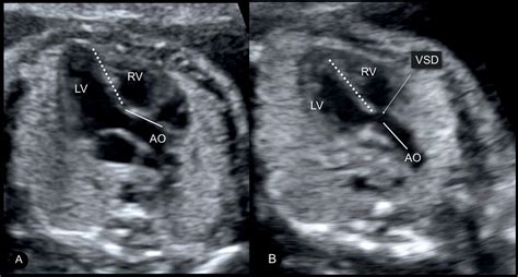 Ultrasound Baby Heart Valves Ababyw