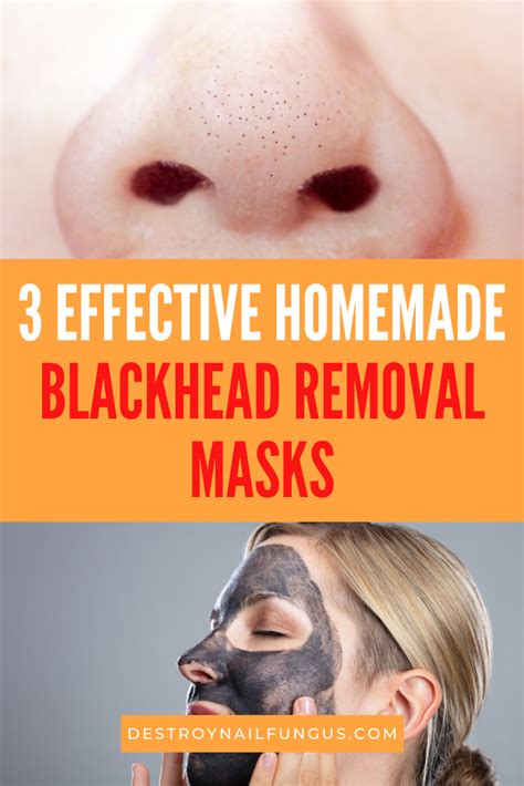 Blackhead Remover Diy 3 Masks To Get Rid Of Blackheads At Home