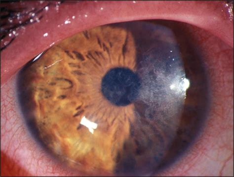 Steroids play a role for treatment in some patients. Nocardia Keratitis in a Contact Lens Wearer. | Cornea ...