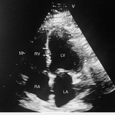 Tte Apical 4 Chamber View Showing Dilated Cardiac Chambers Including