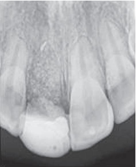 Radiographic Appearance Of Dental Tissues And Materials Pocket Dentistry