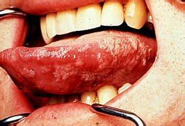 The lateral tongue location differentiates this condition from hairy tongue. Gallery - Leukoplakia | Teeth Relief