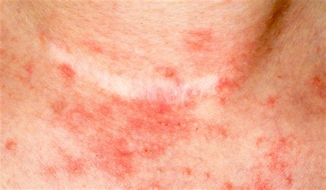 Psoriasis Linked To Risk Of Having And Dying From Cancer Study Finds